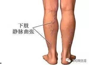 静脉曲张穿丝袜,静脉曲张患者的生活新篇章